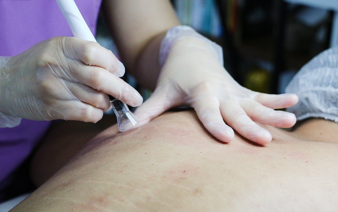 Limpeza de pele nas costas impactoEA Limpeza de pele nas costas - Imagem 1
