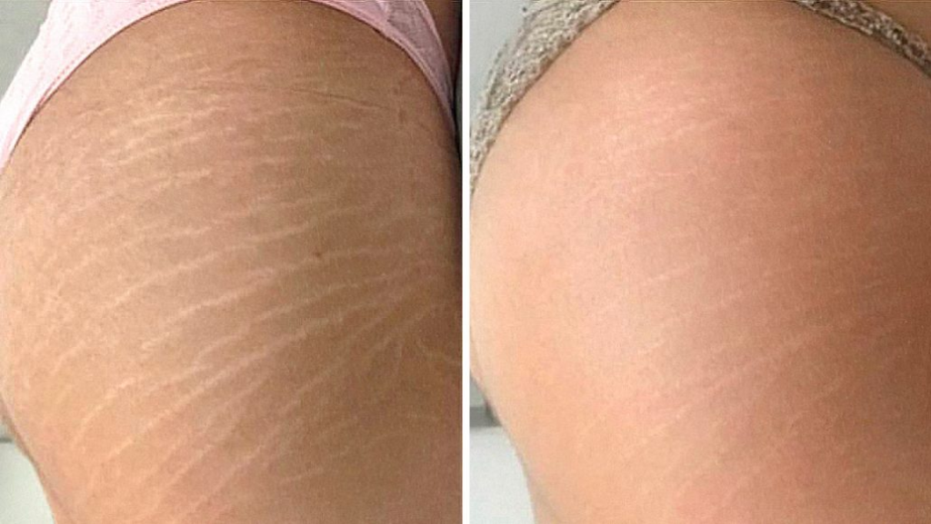 Tratamento para Estrias Método Microderme